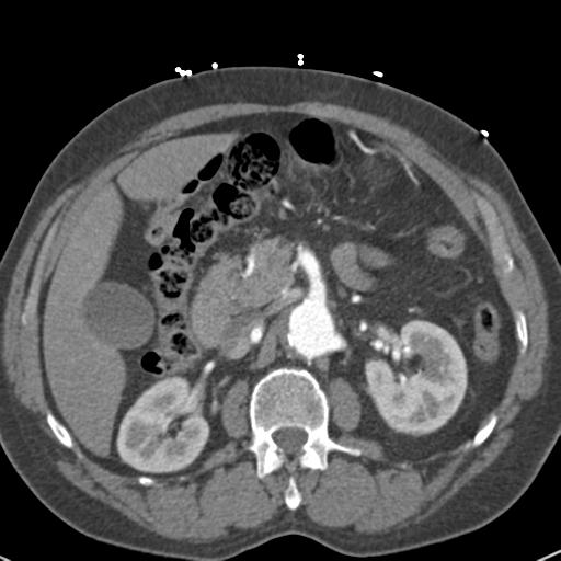File:Aortic intramural hematoma (Radiopaedia 31139-31838 B 97).jpg
