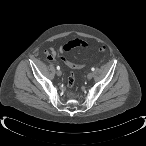 Aortic intramural hematoma (Radiopaedia 34260-35540 B 81).png