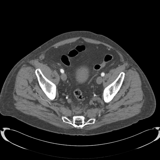 Aortic intramural hematoma (Radiopaedia 34260-35540 B 83).png