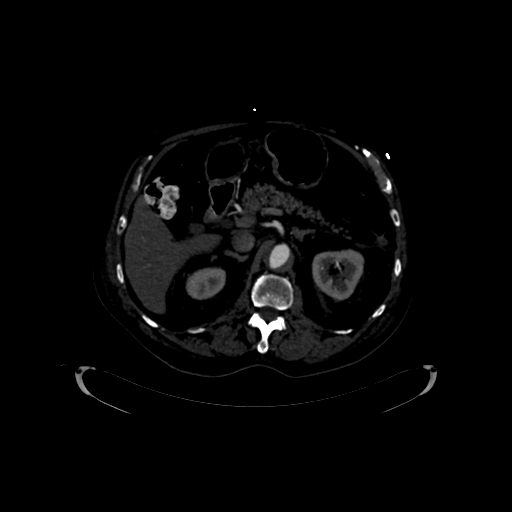 Aortic intramural hematoma (Radiopaedia 34260-35540 C 1).png