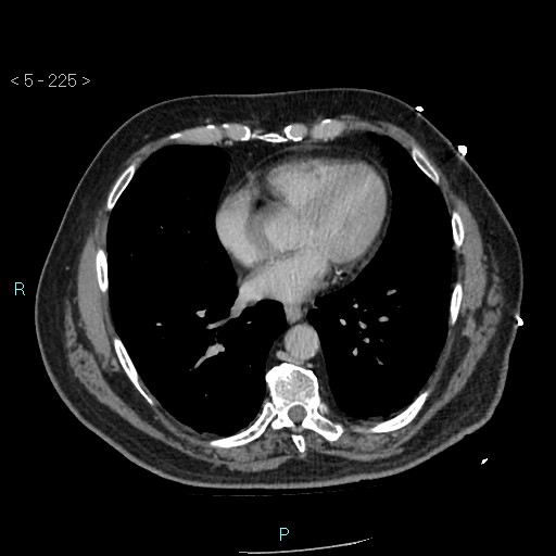 Aortic intramural hematoma (Radiopaedia 48463-53380 C 101).jpg