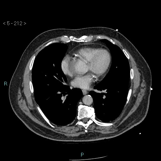 Aortic intramural hematoma (Radiopaedia 48463-53380 C 96).jpg