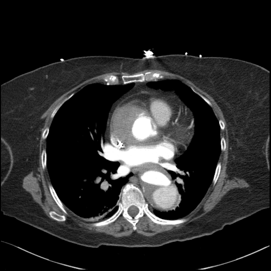 Aortic intramural hematoma with dissection and intramural blood pool (Radiopaedia 77373-89491 B 67).jpg