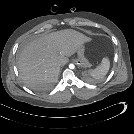 Aortic transection, diaphragmatic rupture and hemoperitoneum in a complex multitrauma patient (Radiopaedia 31701-32622 A 77).jpg