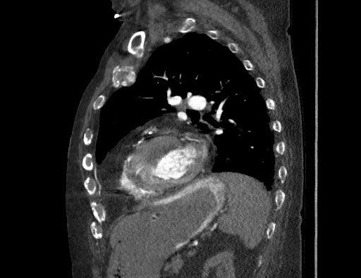 Aortoesophageal fistula with endovascular repair (Radiopaedia 73781-84592 Sagittal C+ CTPA 133).jpg