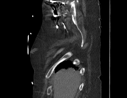Aortoesophageal fistula with endovascular repair (Radiopaedia 73781-84592 Sagittal C+ CTPA 7).jpg