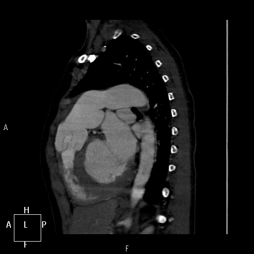 File:Aortopulmonary septal defect (Radiopaedia 41990-45013 Sagittal C+ CTPA 16).jpg
