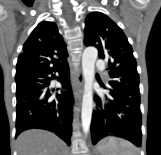 File:Aortopulmonary window, interrupted aortic arch and large PDA giving the descending aorta (Radiopaedia 35573-37074 D 46).jpg