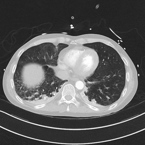Apical bullous disease in a heavy smoker (Radiopaedia 33067-34092 Axial lung window 46).png