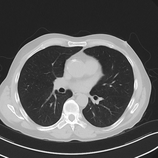 Apical pulmonary metastasis (Radiopaedia 46338-50754 Axial non-contrast 34).png
