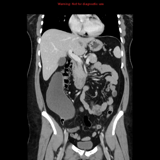 File:Appendiceal mucinous cystadenoma (Radiopaedia 8263-9111 B 32).jpg