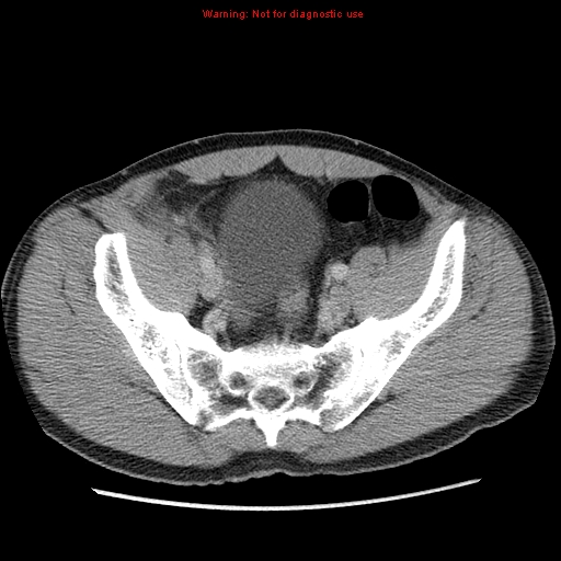 File:Appendicitis and renal cell carcinoma (Radiopaedia 17063-16760 A 46).jpg
