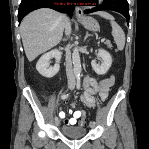 File:Appendicitis mass in inguinal hernia (Radiopaedia 26858-27029 B 38).jpg