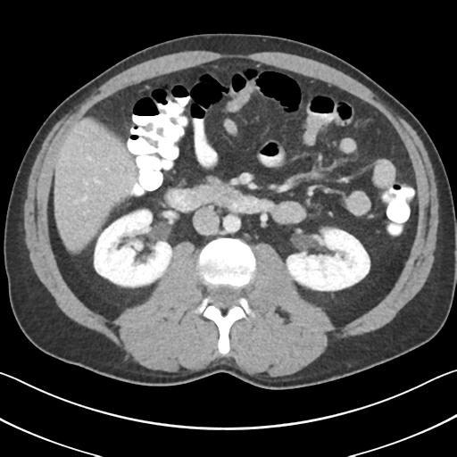 File:Appendicitis with cecal bar sign (Radiopaedia 31878-32830 B 36).jpg