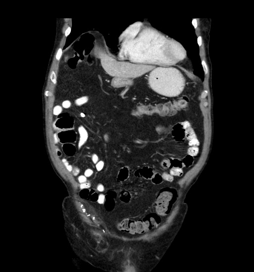 File:Appendicitis with localized perforation and abscess formation (Radiopaedia 49035-54130 B 14).jpg
