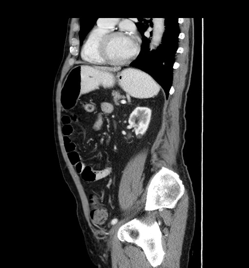 Appendicitis with localized perforation and abscess formation (Radiopaedia 49035-54130 C 43).jpg