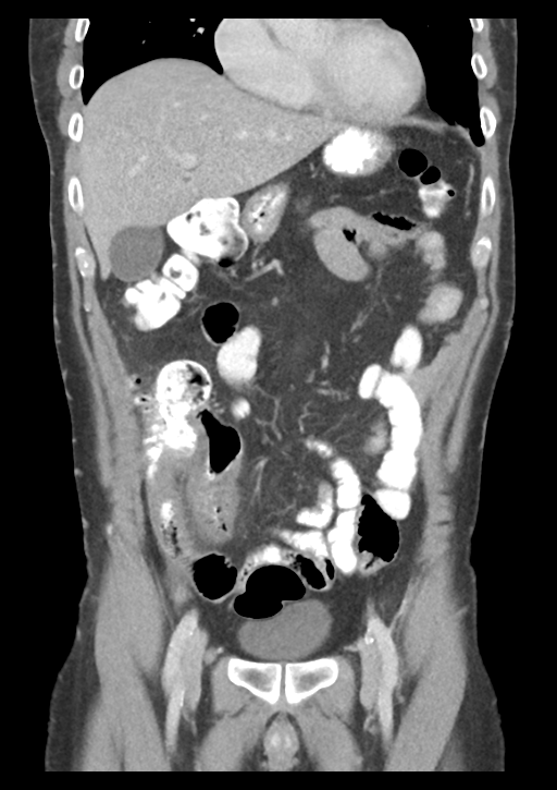 Appendicitis with thickening of the terminal ileum (Radiopaedia 42432-45550 B 19).png