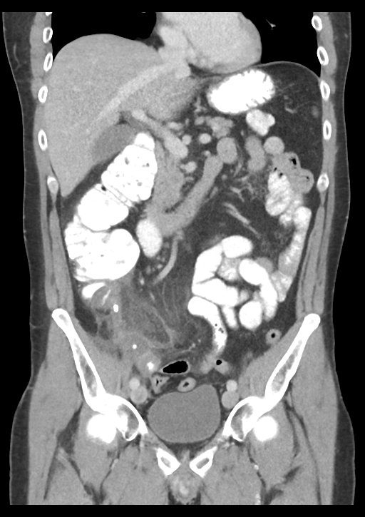 Appendicitis with thickening of the terminal ileum (Radiopaedia 42432-45550 B 26).png