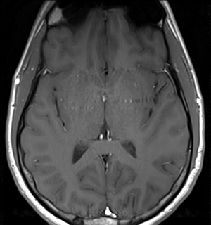 File:Arachnoid cyst - cerebellopontine angle (Radiopaedia 59689-67083 Axial T1 24).png