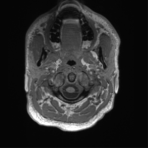 File:Arachnoid cyst with subdural hematoma (Radiopaedia 85892-101743 Axial T1 3).png
