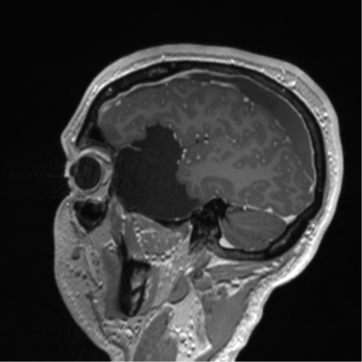 Arachnoid cyst with subdural hematoma (Radiopaedia 85892-101743 Sagittal T1 C+ 26).png