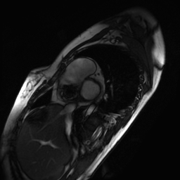Arrhythmogenic right ventricular cardiomyopathy (Radiopaedia 87505-103850 short axis Cine SSFP 222).jpg