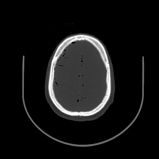 Arrow injury to the brain (Radiopaedia 72101-82607 Axial bone window 85).jpg
