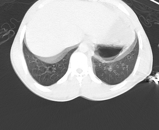 File:Arrow injury to the chest (Radiopaedia 75223-86321 Axial lung window 84).jpg