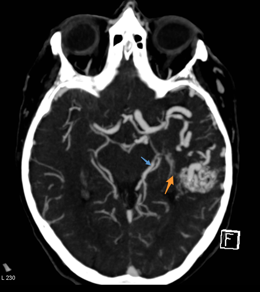 File:Arteriovenous malformation - cerebral (Radiopaedia 8172-14683 Figure 3 1).png