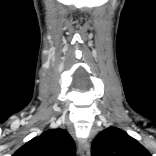 Arteriovenous malformation of the neck (Radiopaedia 53935-60062 D 23).jpg