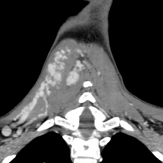 Arteriovenous malformation of the neck (Radiopaedia 53935-60062 D 40).jpg