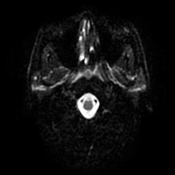 File:Artery of Percheron infarction (Radiopaedia 27975-28230 Axial DWI 28).jpg
