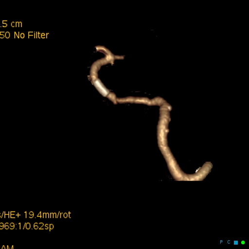 File:Artifactual basilar artery stenosis due to metallic stent (Radiopaedia 31206-31923 C 2).jpg