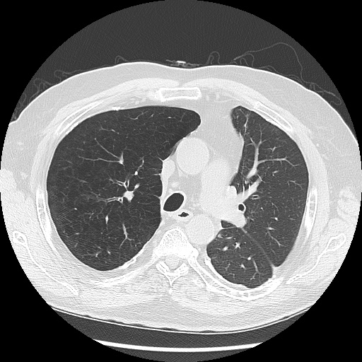 Asbestos-related pleural disease (Radiopaedia 74366-85250 Axial lung window 45).jpg