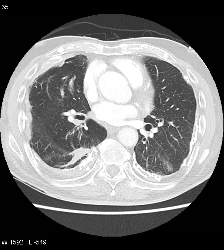 Asbestos related lung and pleural disease (Radiopaedia 14377-14301 A 32).jpg