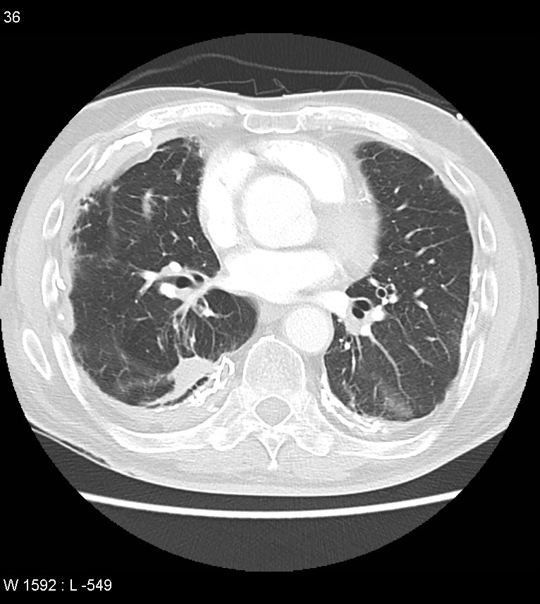 Asbestos related lung and pleural disease (Radiopaedia 14377-14301 A 33).jpg
