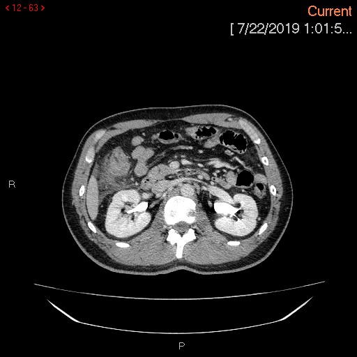 Ascending colonic diverticulum mimicking acute appendicitis (Radiopaedia 69943-80198 A 63).jpg