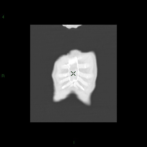 File:Aspergilloma (Radiopaedia 14842-14787 Coronal lung window 1).jpg