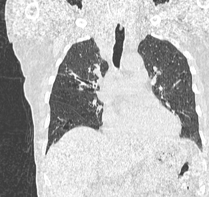 Aspergilloma (Radiopaedia 44592-48327 Coronal lung window 54).jpg