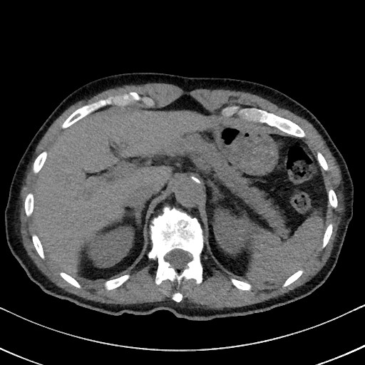 Aspergilloma on background pulmonary fibrosis (Radiopaedia 60942-68757 Axial non-contrast 58).jpg