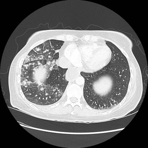 Aspiration pneumonia secondary to laparoscopic banding (Radiopaedia 18345-18183 lung window 86).jpg