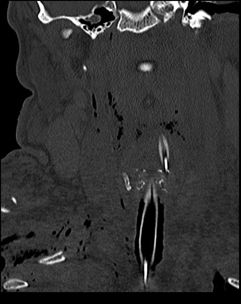 Atlanto-occipital dissociation - Traynelis type 1 (Radiopaedia 87570-103948 Coronal bone window 23).jpg