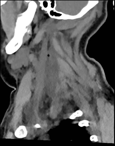 Atlanto-occipital dissociation - Traynelis type 1 (Radiopaedia 87570-103948 D 65).jpg