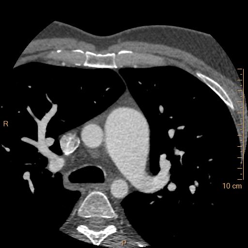 File:Atrial septal defect (upper sinus venosus type) with partial anomalous pulmonary venous return into superior vena cava (Radiopaedia 73228-83961 A 32).jpg