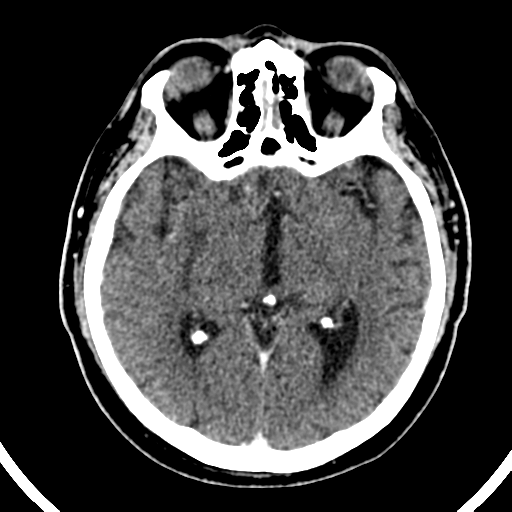 File:Atypical meningioma (WHO grade II) with brain invasion (Radiopaedia 57767-64728 Axial C+ 32).png