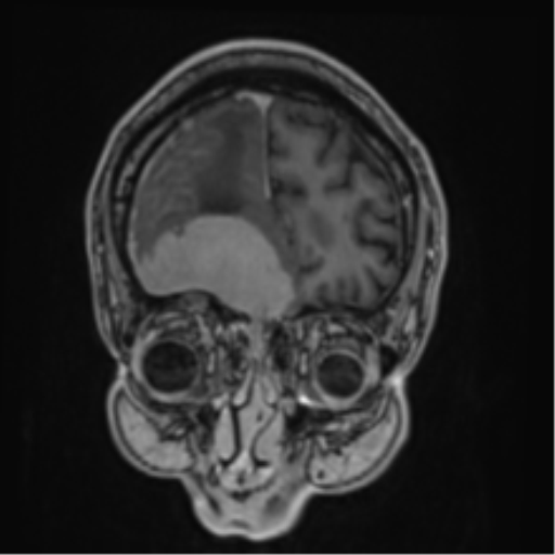 Atypical meningioma (WHO grade II) with brain invasion (Radiopaedia 57767-64729 Coronal T1 C+ 13).png