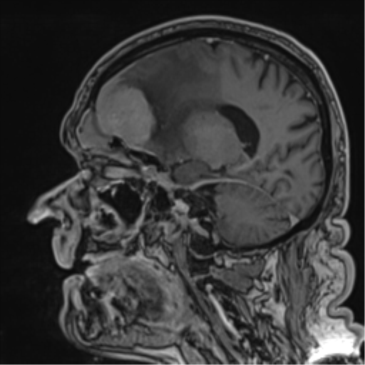 Atypical meningioma (WHO grade II) with brain invasion (Radiopaedia 57767-64729 Sagittal T1 C+ 42).png