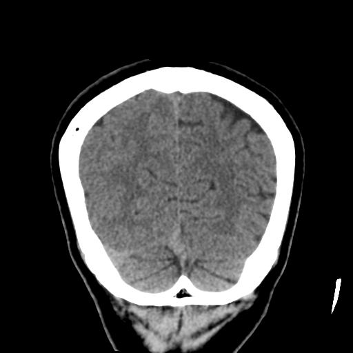 Atypical meningioma (WHO grade II) with osseous invasion (Radiopaedia 53654-59715 Coronal non-contrast 52).png