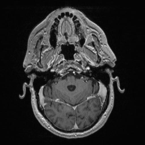 Atypical meningioma (grade II) - en plaque (Radiopaedia 29633-30147 Axial T1 C+ 52).jpg