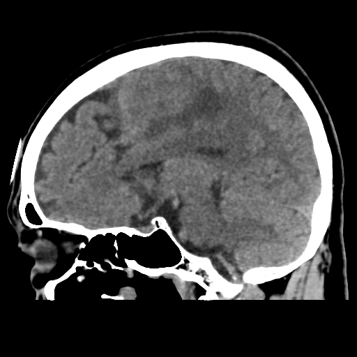 Atypical meningioma with skull invasion (Radiopaedia 34357-35649 E 26).png